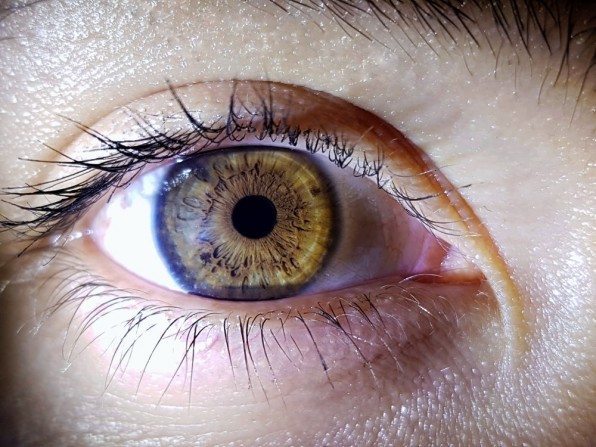 Trombose retiniana ou obstrução venosa  da retina: sempre bom ter atenção